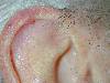 Condrodermatite (800Wx600H) - Condrodermatite nodulare dell'elice. Cortesia di Emilio Sani, dermatologo a Collecchio (PR).<br> Per concessione di www.listaippocrate.it: atlante dermatologico 