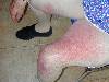 dermatite da FANS (800Wx600H) - Dermatite allergica da contatto con FANS. Cortesia di Emilio Sani, dermatologo a Collecchio (PR).<br> Per concessione di www.listaippocrate.it: atlante dermatologico 